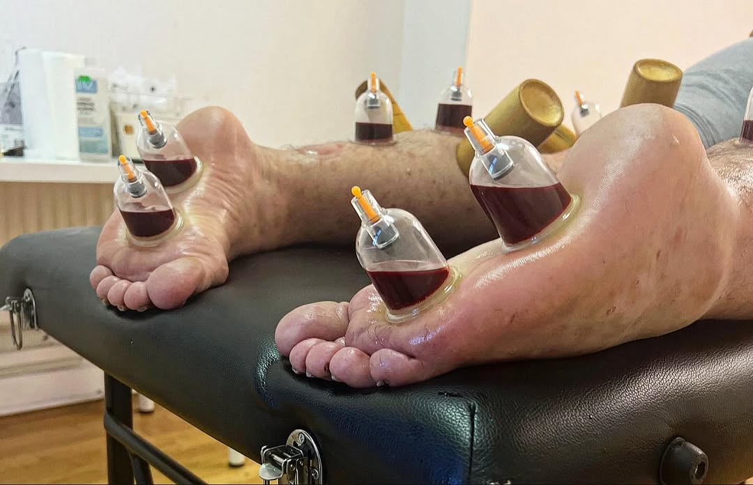 Hijama cupping therapy for knee pain treatment: the natural path to lasting relief Knee pain natural treatment natural knee pain treatment cupping on knee knee joint pain treatment in hyderabad cupping knee pain cupping therapy knee pain knee pain treatment hyderabad cupping therapy for knee pain knee pain hospital in hyderabad knee pain specialist in hyderabad best knee pain treatment in hyderabad hijama for knee pain knee treatment without surgery in hyderabad knee pain cupping therapy cupping knee arthritis hijama therapy for knee pain wet cupping for knee pain advanced spine and knee hospital banjara hills hijama treatment for knee pain knee pain treatment in hyderabad