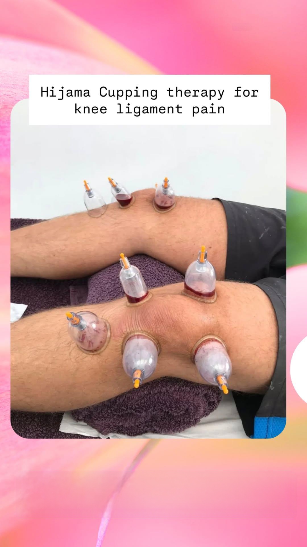 Hijama cupping therapy for knee pain treatment: the natural path to lasting relief Knee pain natural treatment natural knee pain treatment cupping on knee knee joint pain treatment in hyderabad cupping knee pain cupping therapy knee pain knee pain treatment hyderabad cupping therapy for knee pain knee pain hospital in hyderabad knee pain specialist in hyderabad best knee pain treatment in hyderabad hijama for knee pain knee treatment without surgery in hyderabad knee pain cupping therapy cupping knee arthritis hijama therapy for knee pain wet cupping for knee pain advanced spine and knee hospital banjara hills hijama treatment for knee pain knee pain treatment in hyderabad