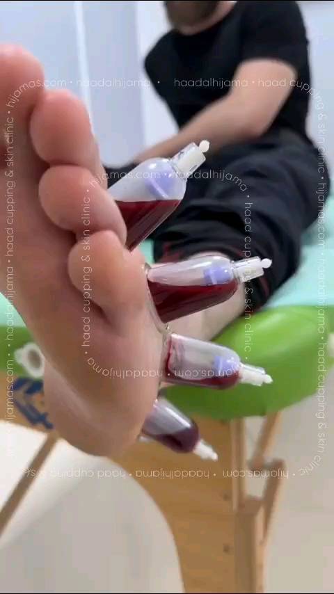 Knee pain natural treatment natural knee pain treatment cupping on knee knee joint pain treatment in hyderabad cupping knee pain cupping therapy knee pain knee pain treatment hyderabad cupping therapy for knee pain knee pain hospital in hyderabad knee pain specialist in hyderabad best knee pain treatment in hyderabad hijama for knee pain knee treatment without surgery in hyderabad knee pain cupping therapy cupping knee arthritis hijama therapy for knee pain wet cupping for knee pain advanced spine and knee hospital banjara hills hijama treatment for knee pain knee pain treatment in hyderabad Knee pain natural treatment natural knee pain treatment cupping on knee knee joint pain treatment in hyderabad cupping knee pain cupping therapy knee pain knee pain treatment hyderabad