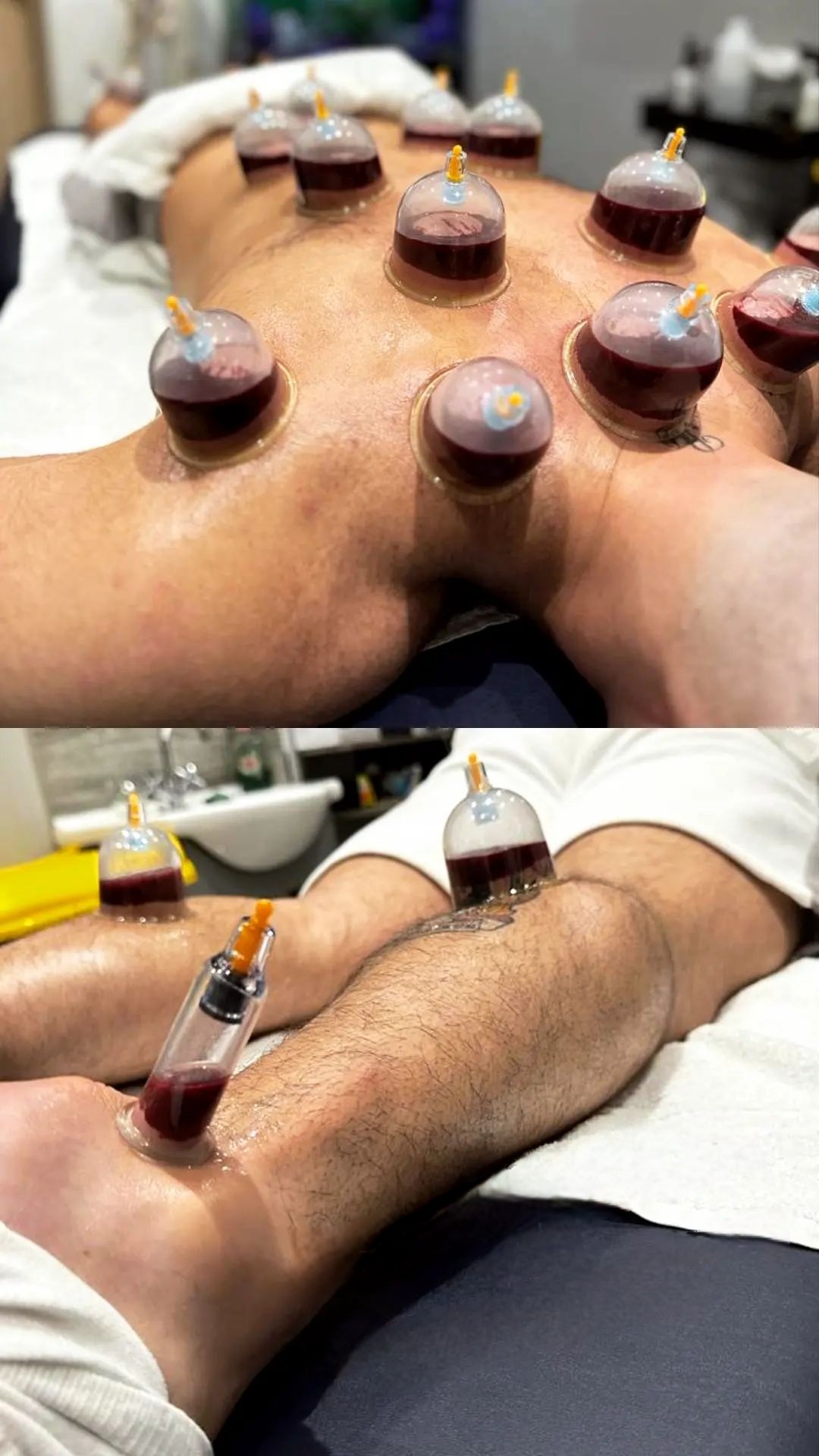 Arthritis cure arthritis in feet treatment arthritis in hands treatment arthritis in hindi treatment arthritis joint pain treatment arthritis rheumatoid treatment arthritis treatment in hyderabad arthritis treatment knee pain best arthritis treatment in hyderabad best doctor for rheumatoid arthritis in hyderabad best rheumatoid arthritis doctor in hyderabad best rheumatoid arthritis treatment cupping knee arthritis cupping therapy for arthritis cupping therapy for arthritis treatment cupping therapy rheumatoid arthritis cupping treatment for arthritis hand arthritis treatment in hyderabad hijama cupping for arthritis knee arthritis cupping knee arthritis treatment without surgery latest treatment for rheumatoid arthritis natural treatment arthritis rheumatoid arthritis best doctors in hyderabad rheumatoid arthritis best treatment in india rheumatoid arthritis doctor in hyderabad rheumatoid arthritis muscle pain treatment rheumatoid arthritis natural cure rheumatoid arthritis natural treatment rheumatoid arthritis new treatment rheumatoid arthritis pain treatment rheumatoid arthritis permanent treatment rheumatoid arthritis specialist in hyderabad rheumatoid arthritis symptoms and treatment rheumatoid arthritis treatment for fingers rheumatoid arthritis treatment hindi rheumatoid arthritis treatment in hyderabad tm joint arthritis treatment treatment for acute gouty arthritis treatment for arthritis of the knee treatment for foot arthritis treatment for psoriasis arthritis treatment for rheumatoid arthritis in fingers treatment for rheumatoid arthritis of the knee treatment for seronegative arthritis treatment of ankle arthritis treatment of gout arthritis treatment of tmj arthritis what is the latest treatment for rheumatoid arthritis what is the treatment of rheumatoid arthritis what is treatment for rheumatoid arthritis which treatment is best for rheumatoid arthritis Arthritis cure arthritis in feet treatment arthritis in hands treatment arthritis in hindi treatment arthritis joint pain treatment arthritis rheumatoid treatment arthritis treatment in hyderabad arthritis treatment knee pain best arthritis treatment in hyderabad best doctor for rheumatoid arthritis in hyderabad best rheumatoid arthritis doctor in hyderabad best rheumatoid arthritis treatment cupping knee arthritis cupping therapy for arthritis cupping therapy for arthritis treatment cupping therapy rheumatoid arthritis cupping treatment for arthritis hand arthritis treatment in hyderabad hijama cupping for arthritis knee arthritis cupping knee arthritis treatment without surgery latest treatment for rheumatoid arthritis natural treatment arthritis rheumatoid arthritis best doctors in hyderabad rheumatoid arthritis best treatment in india rheumatoid arthritis doctor in hyderabad rheumatoid arthritis muscle pain treatment rheumatoid arthritis natural cure rheumatoid arthritis natural treatment rheumatoid arthritis new treatment rheumatoid arthritis pain treatment rheumatoid arthritis permanent treatment rheumatoid arthritis specialist in hyderabad rheumatoid arthritis symptoms and treatment rheumatoid arthritis treatment for fingers rheumatoid arthritis treatment hindi rheumatoid arthritis treatment in hyderabad tm joint arthritis treatment treatment for acute gouty arthritis treatment for arthritis of the knee treatment for foot arthritis treatment for psoriasis arthritis treatment for rheumatoid arthritis in fingers treatment for rheumatoid arthritis of the knee treatment for seronegative arthritis treatment of ankle arthritis treatment of gout arthritis treatment of tmj arthritis what is the latest treatment for rheumatoid arthritis what is the treatment of rheumatoid arthritis what is treatment for rheumatoid arthritis which treatment is best for rheumatoid arthritis