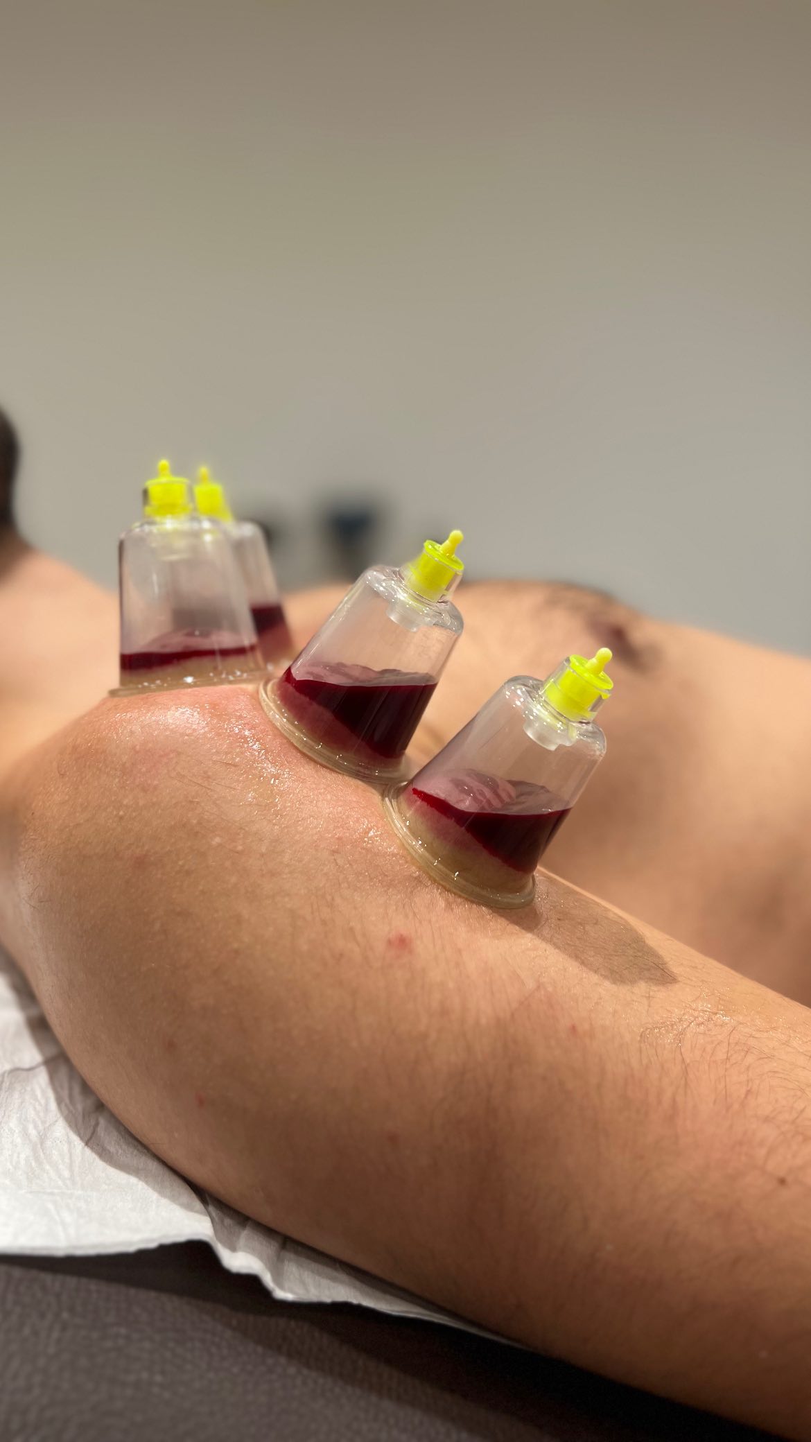 Arthritis cure arthritis in feet treatment arthritis in hands treatment arthritis in hindi treatment arthritis joint pain treatment arthritis rheumatoid treatment arthritis treatment in hyderabad arthritis treatment knee pain best arthritis treatment in hyderabad best doctor for rheumatoid arthritis in hyderabad best rheumatoid arthritis doctor in hyderabad best rheumatoid arthritis treatment cupping knee arthritis cupping therapy for arthritis cupping therapy for arthritis treatment cupping therapy rheumatoid arthritis cupping treatment for arthritis hand arthritis treatment in hyderabad hijama cupping for arthritis knee arthritis cupping knee arthritis treatment without surgery latest treatment for rheumatoid arthritis natural treatment arthritis rheumatoid arthritis best doctors in hyderabad rheumatoid arthritis best treatment in india rheumatoid arthritis doctor in hyderabad rheumatoid arthritis muscle pain treatment rheumatoid arthritis natural cure rheumatoid arthritis natural treatment rheumatoid arthritis new treatment rheumatoid arthritis pain treatment rheumatoid arthritis permanent treatment rheumatoid arthritis specialist in hyderabad rheumatoid arthritis symptoms and treatment rheumatoid arthritis treatment for fingers rheumatoid arthritis treatment hindi rheumatoid arthritis treatment in hyderabad tm joint arthritis treatment treatment for acute gouty arthritis treatment for arthritis of the knee treatment for foot arthritis treatment for psoriasis arthritis treatment for rheumatoid arthritis in fingers treatment for rheumatoid arthritis of the knee treatment for seronegative arthritis treatment of ankle arthritis treatment of gout arthritis treatment of tmj arthritis what is the latest treatment for rheumatoid arthritis what is the treatment of rheumatoid arthritis what is treatment for rheumatoid arthritis which treatment is best for rheumatoid arthritis Arthritis cure arthritis in feet treatment arthritis in hands treatment arthritis in hindi treatment arthritis joint pain treatment arthritis rheumatoid treatment arthritis treatment in hyderabad arthritis treatment knee pain best arthritis treatment in hyderabad best doctor for rheumatoid arthritis in hyderabad best rheumatoid arthritis doctor in hyderabad best rheumatoid arthritis treatment cupping knee arthritis cupping therapy for arthritis cupping therapy for arthritis treatment cupping therapy rheumatoid arthritis cupping treatment for arthritis hand arthritis treatment in hyderabad hijama cupping for arthritis knee arthritis cupping knee arthritis treatment without surgery latest treatment for rheumatoid arthritis natural treatment arthritis rheumatoid arthritis best doctors in hyderabad rheumatoid arthritis best treatment in india rheumatoid arthritis doctor in hyderabad rheumatoid arthritis muscle pain treatment rheumatoid arthritis natural cure rheumatoid arthritis natural treatment rheumatoid arthritis new treatment rheumatoid arthritis pain treatment rheumatoid arthritis permanent treatment rheumatoid arthritis specialist in hyderabad rheumatoid arthritis symptoms and treatment rheumatoid arthritis treatment for fingers rheumatoid arthritis treatment hindi rheumatoid arthritis treatment in hyderabad tm joint arthritis treatment treatment for acute gouty arthritis treatment for arthritis of the knee treatment for foot arthritis treatment for psoriasis arthritis treatment for rheumatoid arthritis in fingers treatment for rheumatoid arthritis of the knee treatment for seronegative arthritis treatment of ankle arthritis treatment of gout arthritis treatment of tmj arthritis what is the latest treatment for rheumatoid arthritis what is the treatment of rheumatoid arthritis what is treatment for rheumatoid arthritis which treatment is best for rheumatoid arthritis